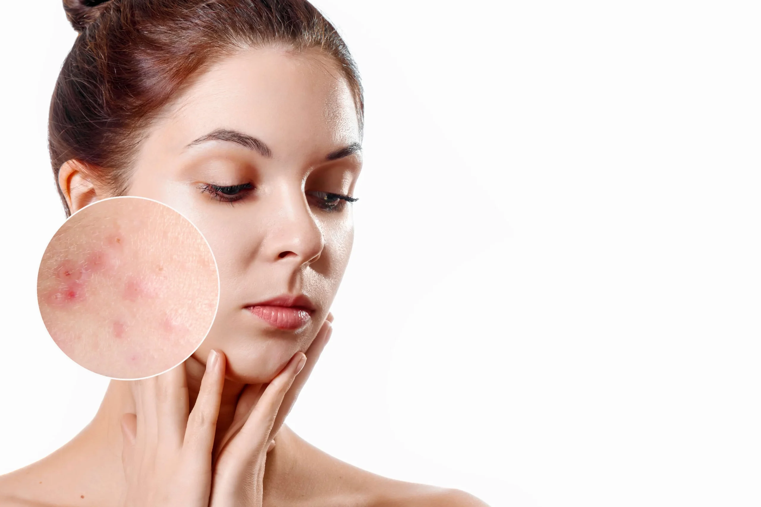 Acne Treatments for Clearer Skin By Skintuition Skincare Boutique, LLC in Pewee Valley, KY